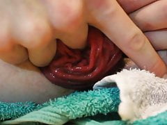 Extreme Anal Prolapsing  with a 8.43cm wide eggplant
