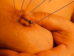bad acupuncture 1
