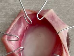 Foreskin torture