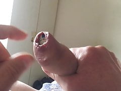 20 casino chips in foreskin - 1 of 2