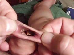 A spoon and 10 batteries in foreskin - 5 minutes