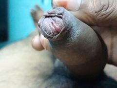 Phimosis and peyronies disease