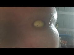 Dilatation anale