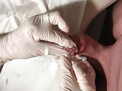 Foreskin closure